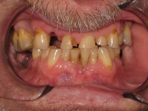 A close up of man's teeth before procedure
