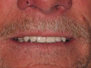 Close up of man showing off his new teeth