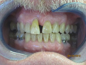Close up of a man's teeth before procedure