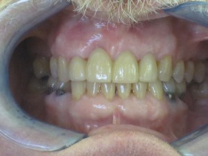 Close up of a man's teeth after dental procedure