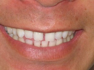 Close up before dental treatment