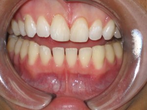 Close up after dental treatment