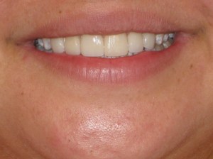A close up of a young women's teeth after treatment