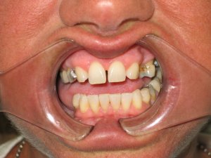 A close up before dental procedure