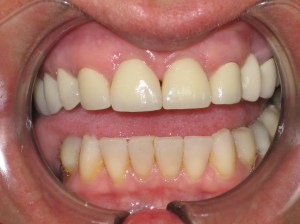 A close up after dental procedure