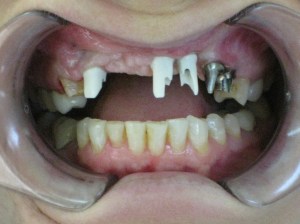 A close up of a patient missing multiple front teeth