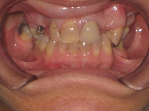 A close up of a mouth before dental procedure
