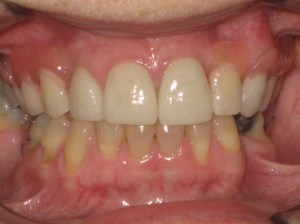 A close up of a mouth after dental procedure