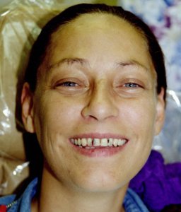 Woman smiling before procedure