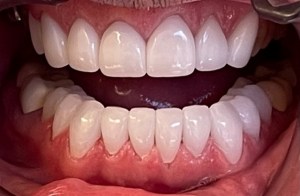 after teeth whitening and dental work